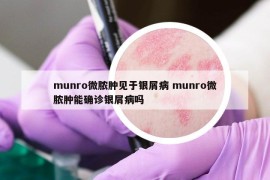 munro微脓肿见于银屑病 munro微脓肿能确诊银屑病吗