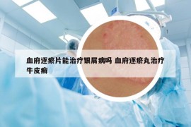 血府逐瘀片能治疗银屑病吗 血府逐瘀丸治疗牛皮癣