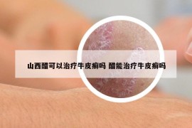 山西醋可以治疗牛皮癣吗 醋能治疗牛皮癣吗