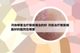 河南哪里治疗银屑病治的好 河南治疗银屑病最好的医院在哪里
