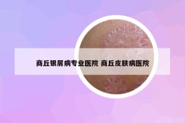 商丘银屑病专业医院 商丘皮肤病医院