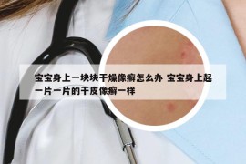 宝宝身上一块块干燥像癣怎么办 宝宝身上起一片一片的干皮像癣一样