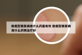 脓疱型银屑病用什么药最有效 脓疱型银屑病用什么药物治疗好