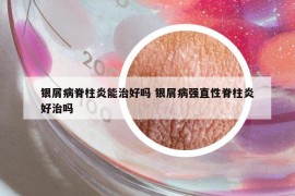 银屑病脊柱炎能治好吗 银屑病强直性脊柱炎好治吗