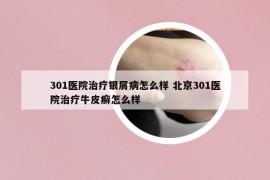 301医院治疗银屑病怎么样 北京301医院治疗牛皮癣怎么样