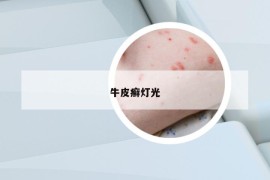 牛皮癣灯光
