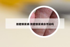 脓胞银屑病 脓胞银屑病会传染吗