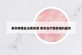 泰安哪里能治银屑病 泰安治疗银屑病的医院