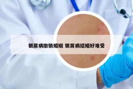 银屑病撤销婚姻 银屑病结婚好难受
