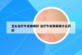 怎么治疗牛皮肤癣好 治疗牛皮肤癣用什么药好