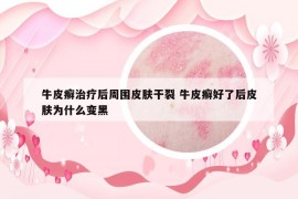 牛皮癣治疗后周围皮肤干裂 牛皮癣好了后皮肤为什么变黑