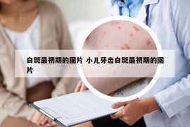 白斑最初期的图片 小儿牙齿白斑最初期的图片