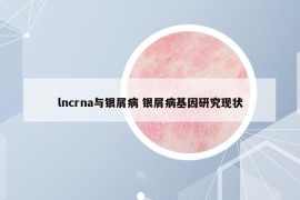 lncrna与银屑病 银屑病基因研究现状