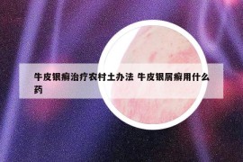 牛皮银癣治疗农村土办法 牛皮银屑癣用什么药