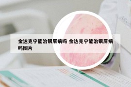 金达克宁能治银屑病吗 金达克宁能治银屑病吗图片