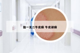 独一无二牛皮癣 牛皮顽癣