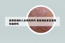 患银屑病的人会得风疹吗 银屑病患者容易得荨麻疹吗