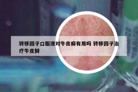 转移因子口服液对牛皮癣有用吗 转移因子治疗牛皮鲜