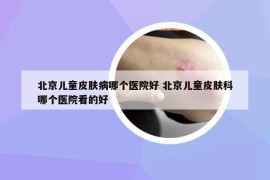 北京儿童皮肤病哪个医院好 北京儿童皮肤科哪个医院看的好