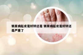 银屑病起皮是好转还是 银屑病起皮是好转还是严重了