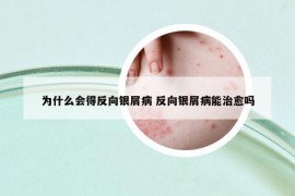 为什么会得反向银屑病 反向银屑病能治愈吗