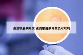 点滴银屑病用艾 点滴银屑病用艾灸可以吗