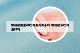 银屑病加重和吃鸡蛋有关系吗 银屑病多吃鸡蛋好吗
