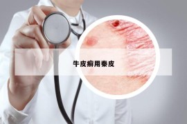 牛皮癣用秦皮