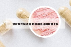 银屑病开裂消退 银屑病消退期皮肤干裂