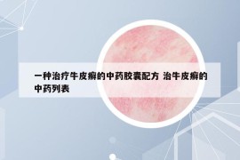 一种治疗牛皮癣的中药胶囊配方 治牛皮癣的中药列表