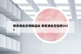 银屑病自愈吧精品帖 银屑病自愈贴吧2017