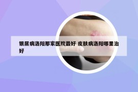 银屑病洛阳那家医院最好 皮肤病洛阳哪里治好