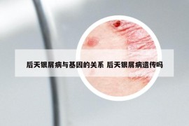 后天银屑病与基因的关系 后天银屑病遗传吗