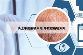 头上牛皮癣晒太阳 牛皮肤癣晒太阳
