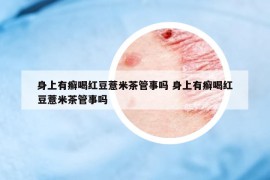 身上有癣喝红豆薏米茶管事吗 身上有癣喝红豆薏米茶管事吗