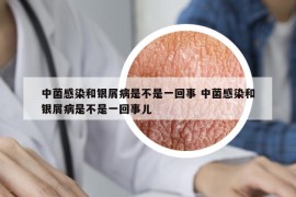中菌感染和银屑病是不是一回事 中菌感染和银屑病是不是一回事儿