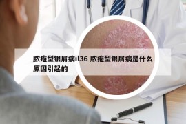脓疱型银屑病il36 脓疱型银屑病是什么原因引起的