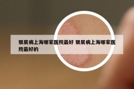 银屑病上海哪家医院最好 银屑病上海哪家医院最好的