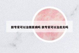 肤专家可以治银屑病吗 肤专家可以治皮炎吗