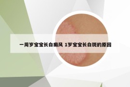 一周岁宝宝长白癜风 1岁宝宝长白斑的原因