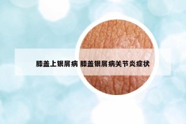 膝盖上银屑病 膝盖银屑病关节炎症状