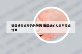 银屑病能吃炒的竹笋妈 银屑病的人能不能吃竹笋