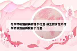 打生物制剂前要做什么检查 强直性脊柱炎打生物制剂前要做什么检查