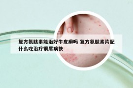 复方氨肽素能治好牛皮癣吗 复方氨肽素片配什么吃治疗银屑病快
