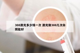 308激光多少钱一次 激光做308几次白斑能好