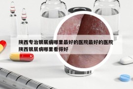 陕西专治银屑病哪里最好的医院最好的医院 陕西银屑病哪里看得好