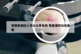 有银屑病的人可以吃草鱼吗 银屑病可以吃鱼嘛
