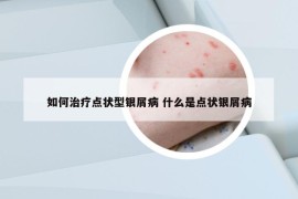 如何治疗点状型银屑病 什么是点状银屑病