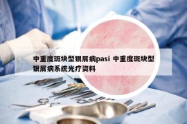 中重度斑块型银屑病pasi 中重度斑块型银屑病系统光疗资料