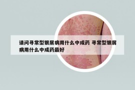 请问寻常型银屑病用什么中成药 寻常型银屑病用什么中成药最好